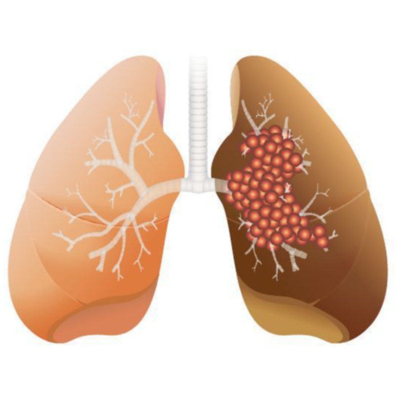 Az NMNnagy adagja gátolja a tüdő adenocarcinomanövekedését